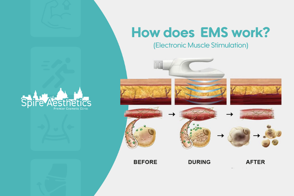 EMS treatment for post pregnancy weight loss treatment Havering