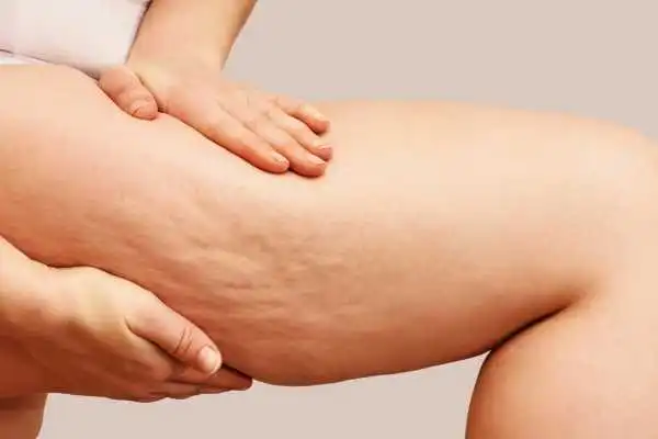 Image of woman showing leg with cellulite Havering