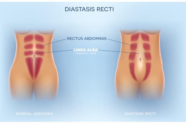 What Non-Surgical Options Are Available for Diastasis Recti Havering?