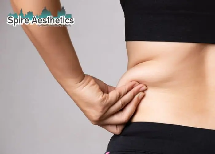Image of woman pinching fat on their hips Havering. Fat Freezing treatment