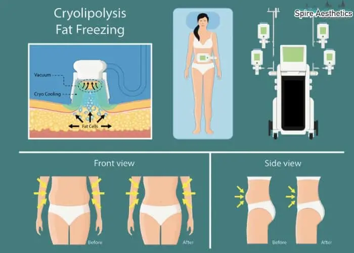 Fat freezing treatment Havering benefits for competitions to remove stubborn fat deposits.