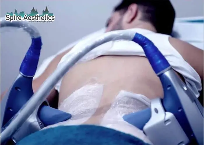Man having fat freezing treatment done on love handles before a competitions Havering to create a sculpted look.