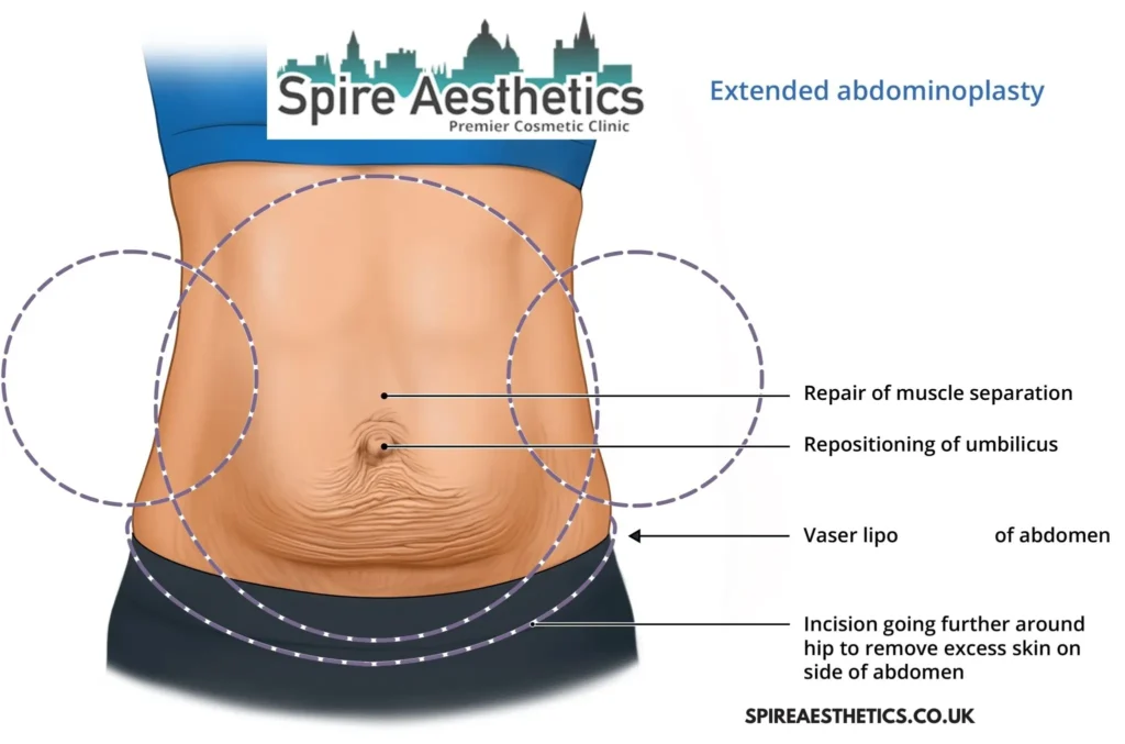 Understanding Loose Skin After Gastric Band Havering Surgery and HIFU Treatment