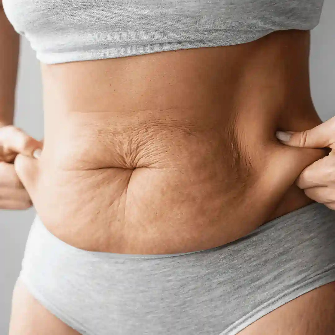 Is It Normal to Have Loose Skin After Pregnancy Havering?