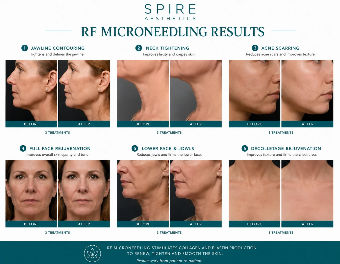RF Microneedling Skin tightening Havering results