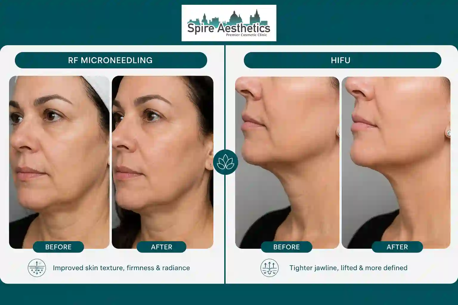 Can RF Microneedling and HIFU Be Combined Havering?