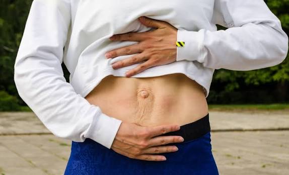 When Could Diastasis Recti Be the Missing Piece of the Puzzle Havering?